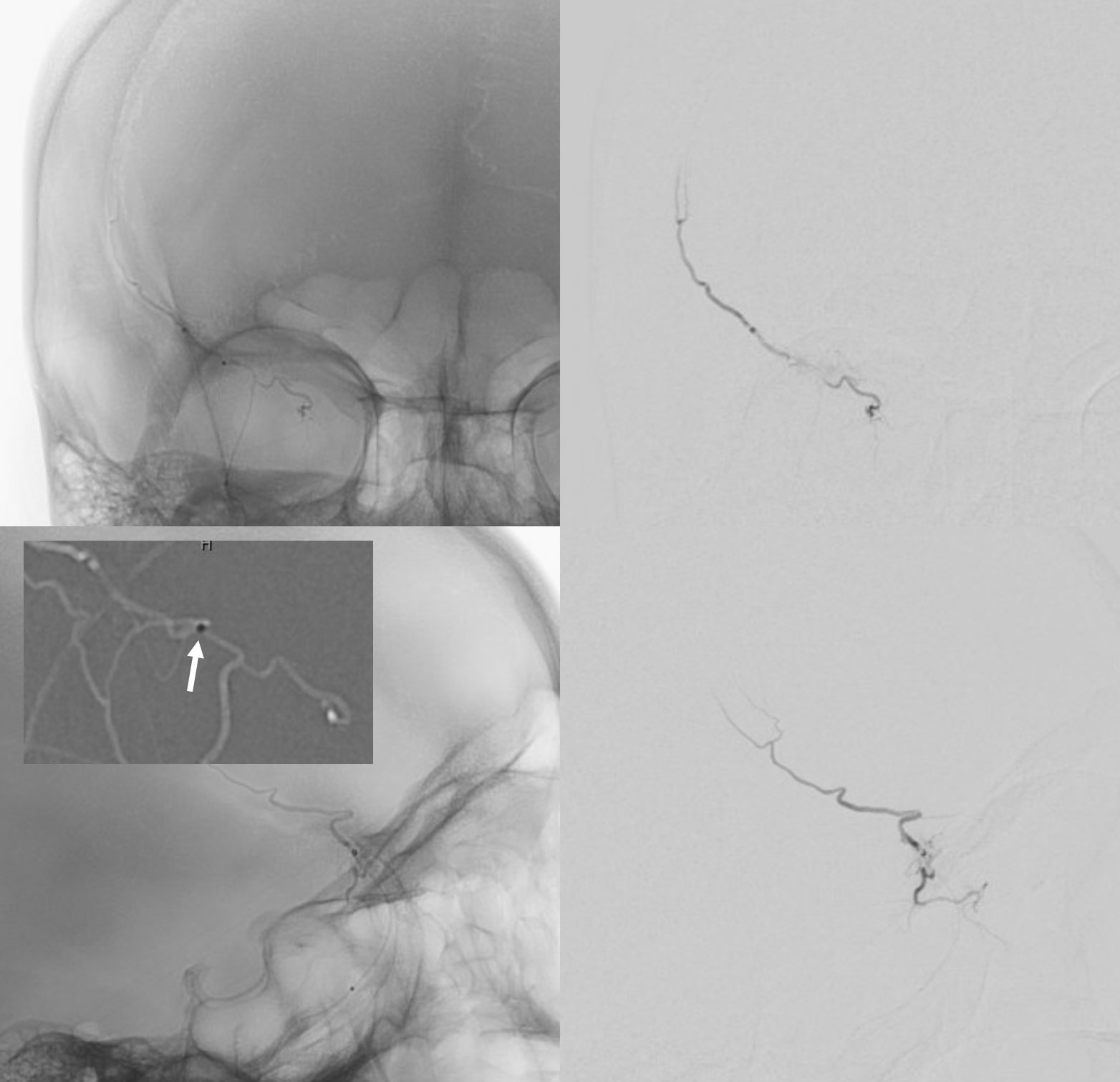 Subdural Embolization Multiple Orbital Anastomoses nBCA Technique